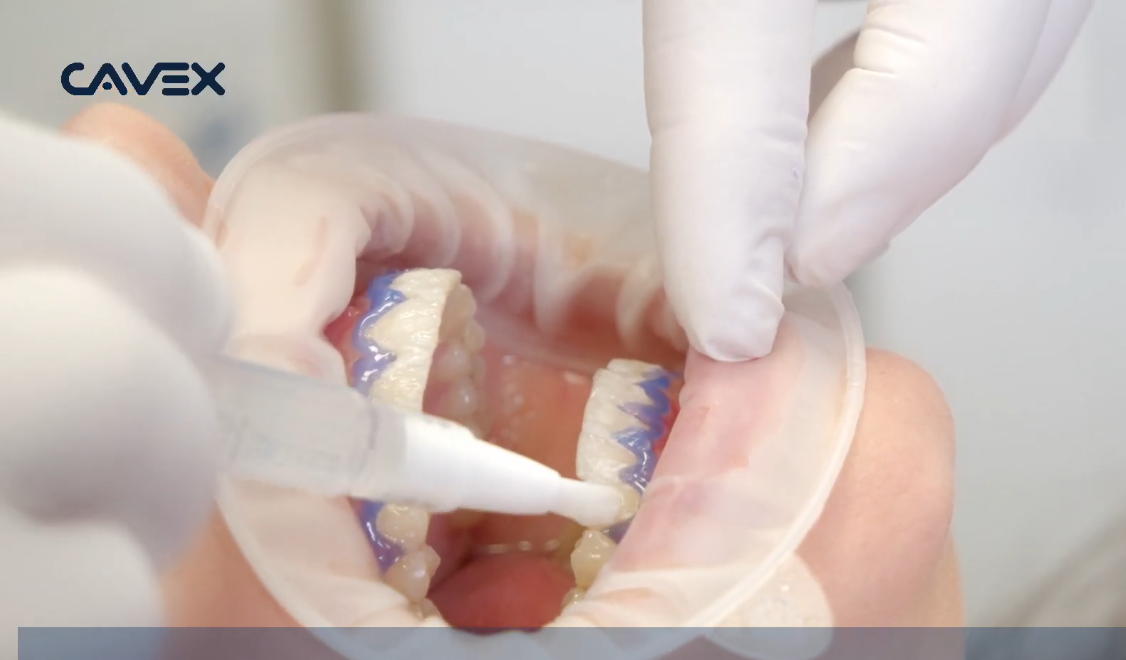 Cavex Bite ve White In-Office: Hızlı ve Etkili Diş Beyazlatma Çözümü