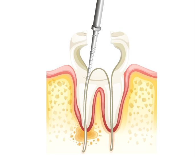 Endodonti 