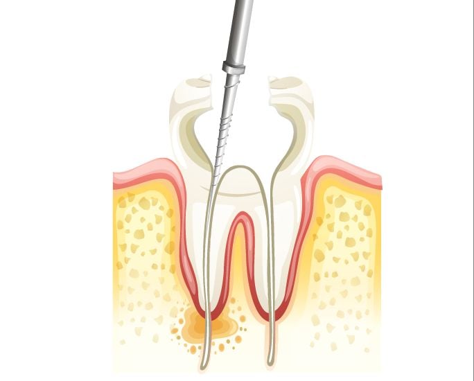 Endodonti 